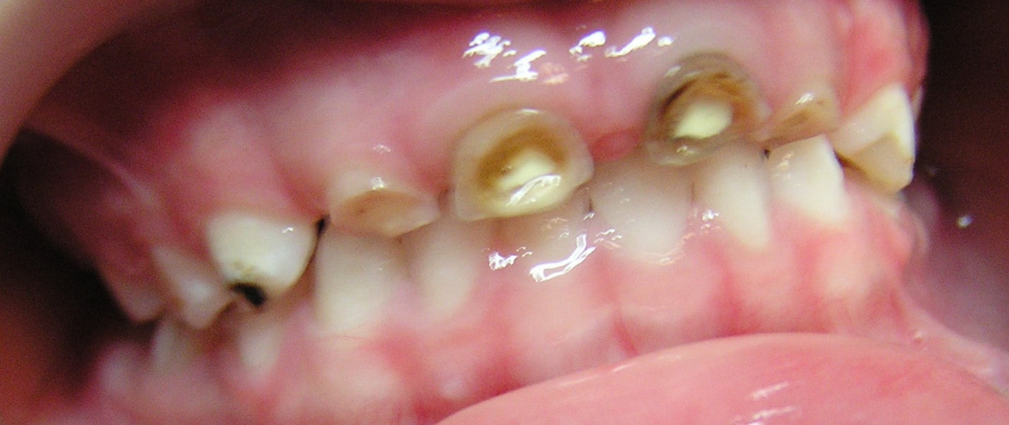 La Carie Du Biberon Dent Bebe Causes Et Manifestations De La Cariedent Bebe