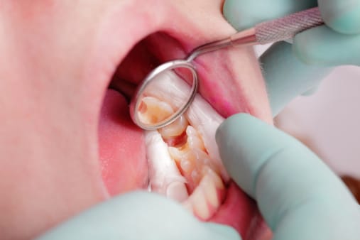 Prévenir les caries