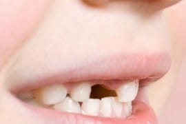 perdre-dents-de-lait